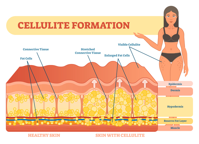 cellulite formation graphic of woman with cellulite on her thighs with a close up the molecular diagram of cells of healthy skin vs cellulite