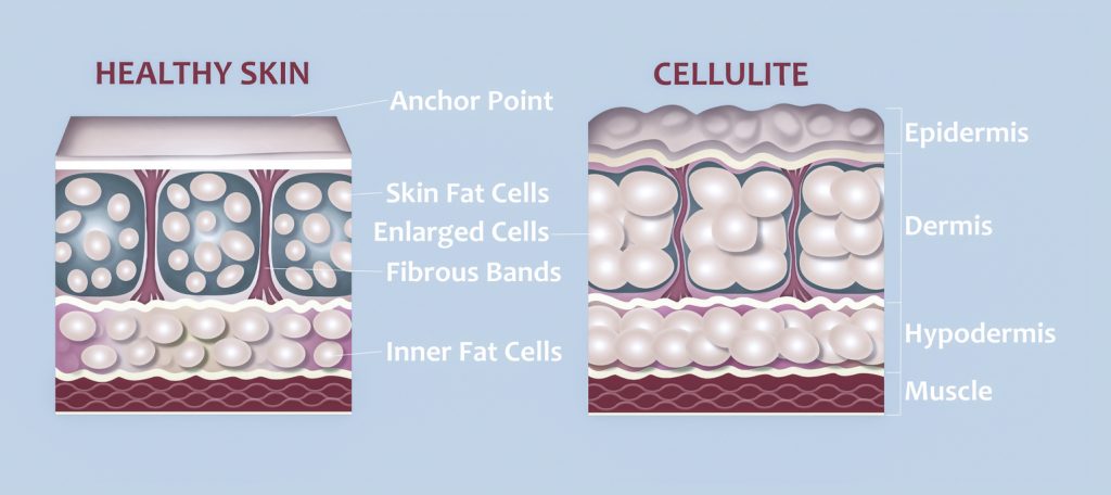 Graphic of cellulite treatment healthy skin vs skin with cellulite forming of underskin cellulite illustration