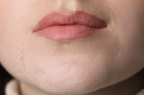 Closeup view of woman with dry skin