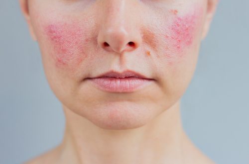 Portrait of young Caucasian woman suffering from rosacea on her face in the acute stage.