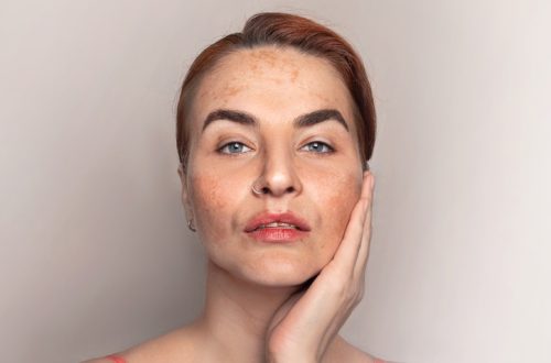 Woman shows face with pigmentation, melasma, freckles, age spots photo.